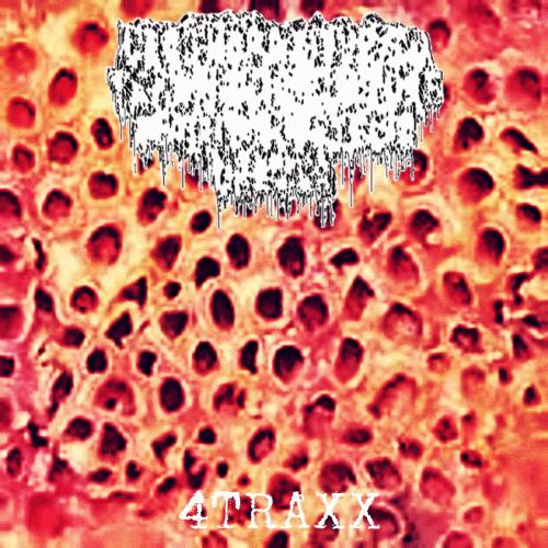 Acanthosis Nigrcans : 4Traxx Acanthosis Nigrcans : 4Traxx